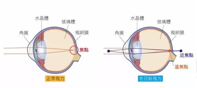500度近視又老花，戴上美麗島多焦鏡煩惱全解決，46歲的周先生樂壞了