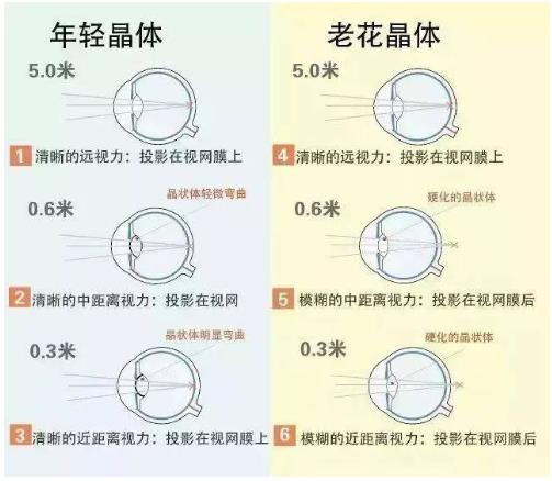 近視就不會老花了嗎？